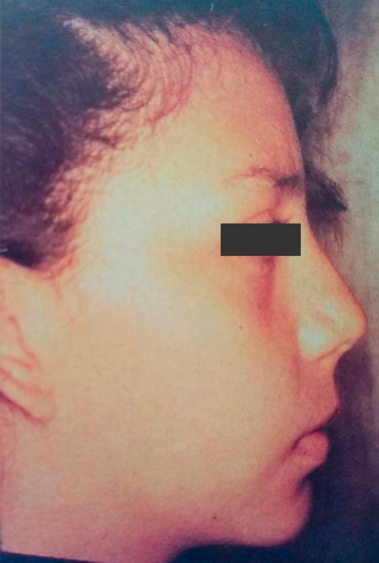 Caso 1, después: rostro en armonía