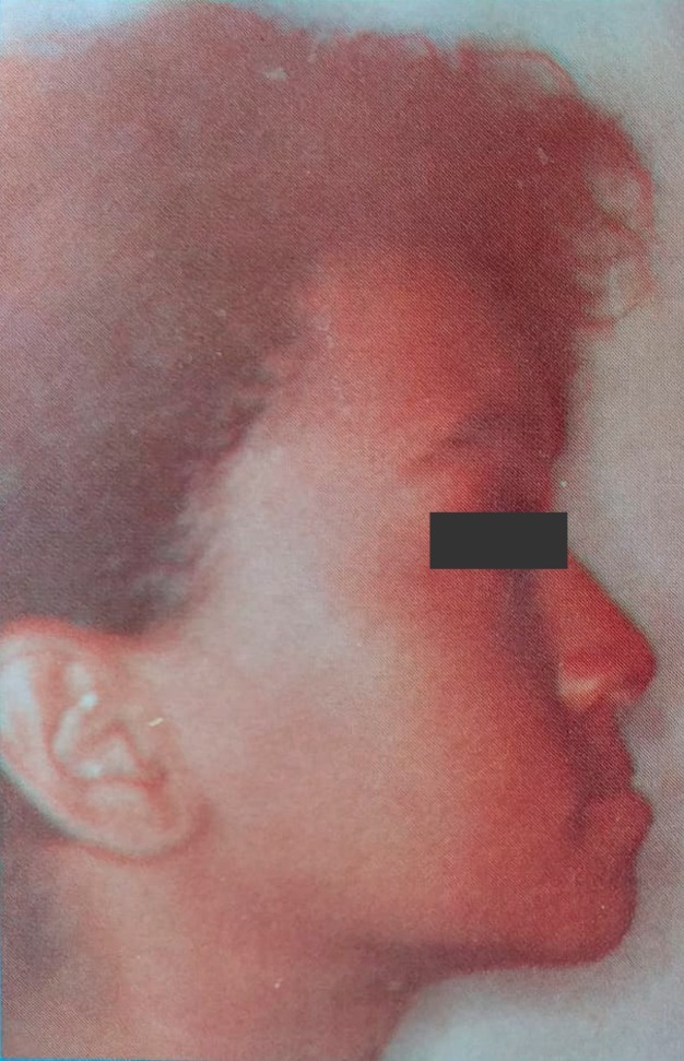 Caso 2, antes: mandíbula prognata