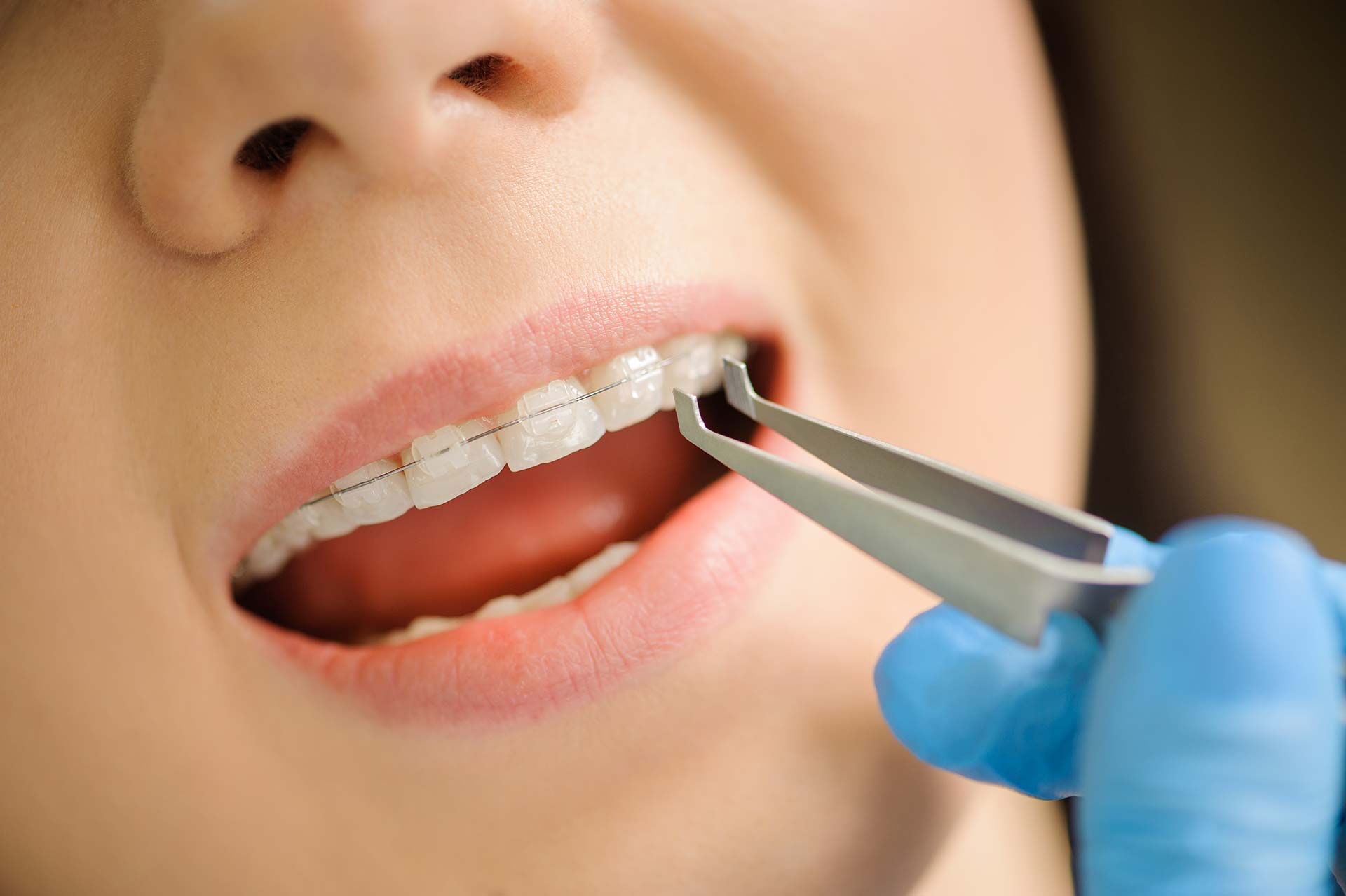 Brackets estéticos de cerámica