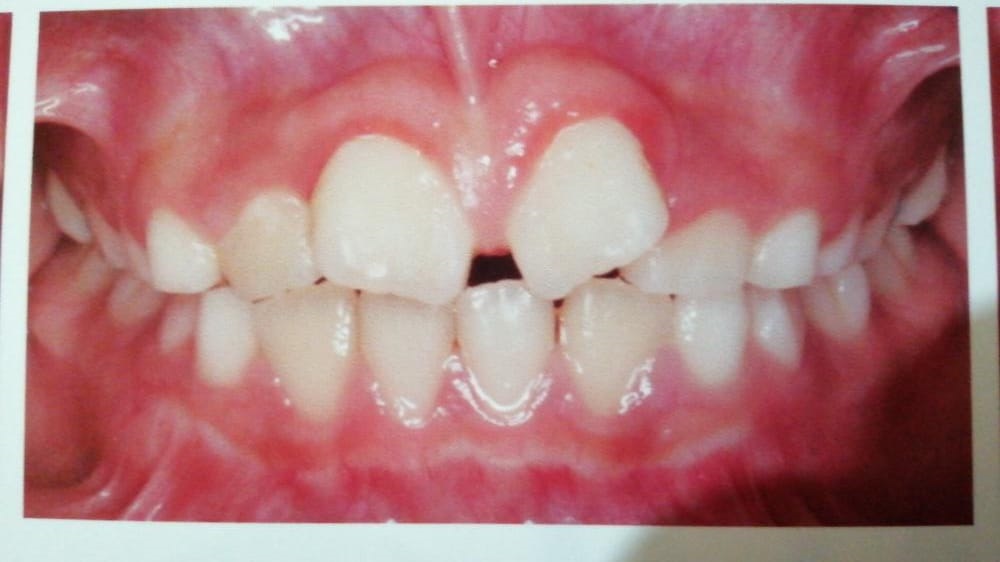 Caso de ortopedia dentofacial, antes