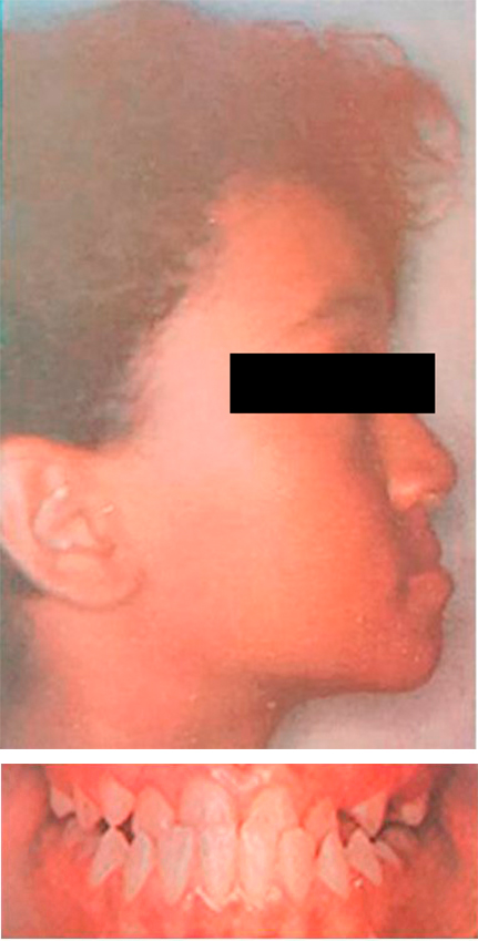 Caso de ortopedia dentofacial, antes