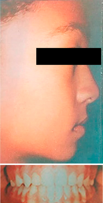 Caso de ortopedia dentofacial, despues