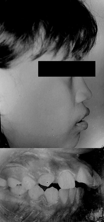 Caso de ortopedia dentofacial, antes
