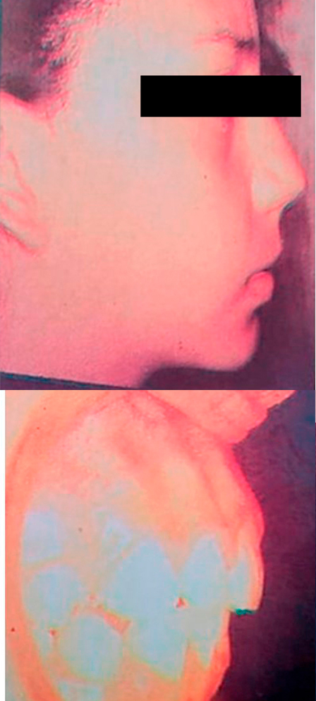 Caso de ortopedia dentofacial, despues