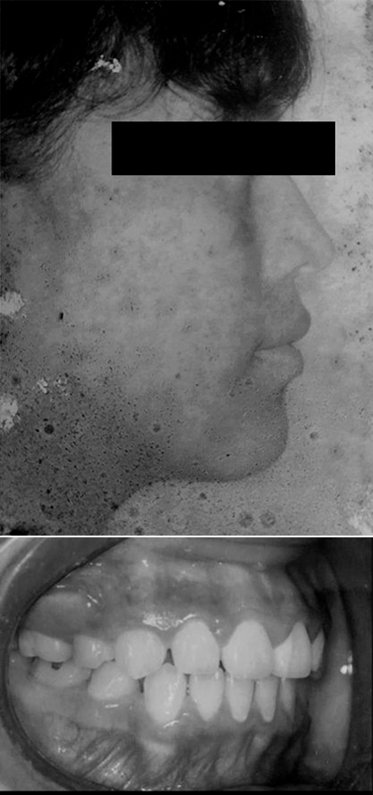 Caso de ortopedia dentofacial, despues