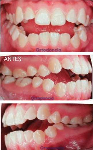 Caso de ortodoncia, antes