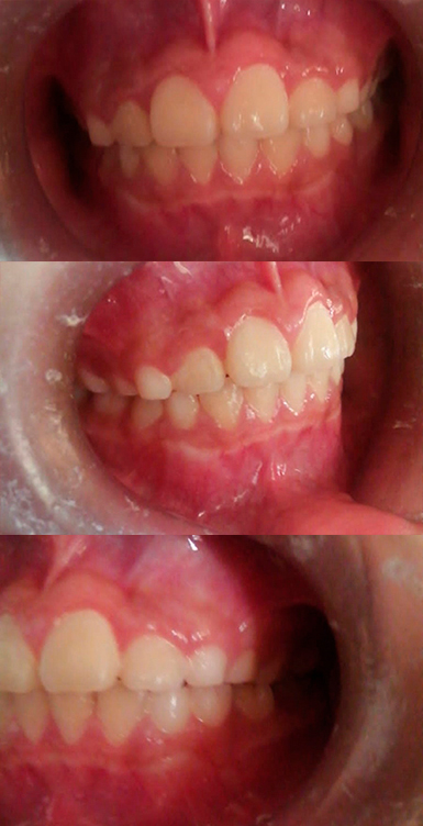 Caso de ortopedia dentofacial, despues