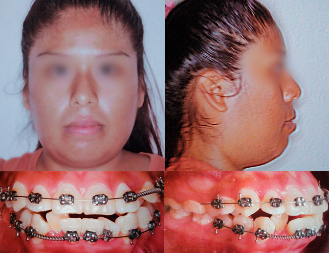 Caso de ortodoncia, antes