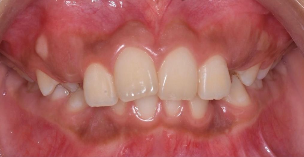 Caso de ortopedia dentofacial, antes