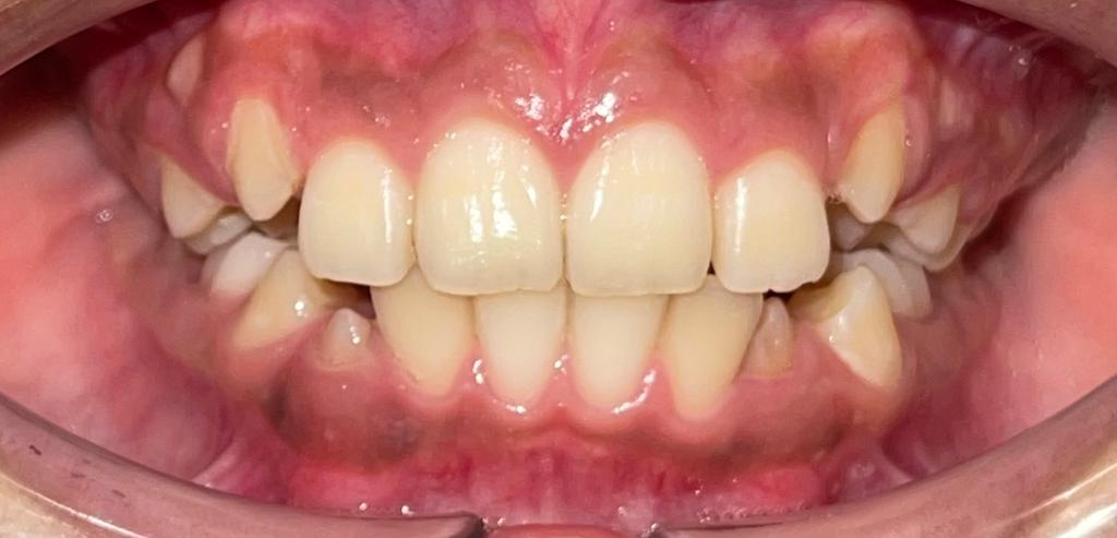 Caso de ortopedia dentofacial, despues