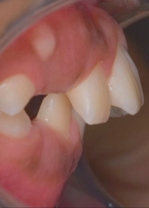 Caso de ortopedia dentofacial, antes