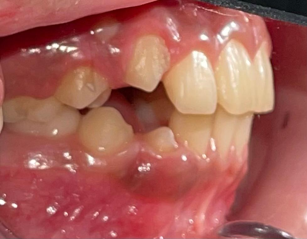 Caso de ortopedia dentofacial, despues
