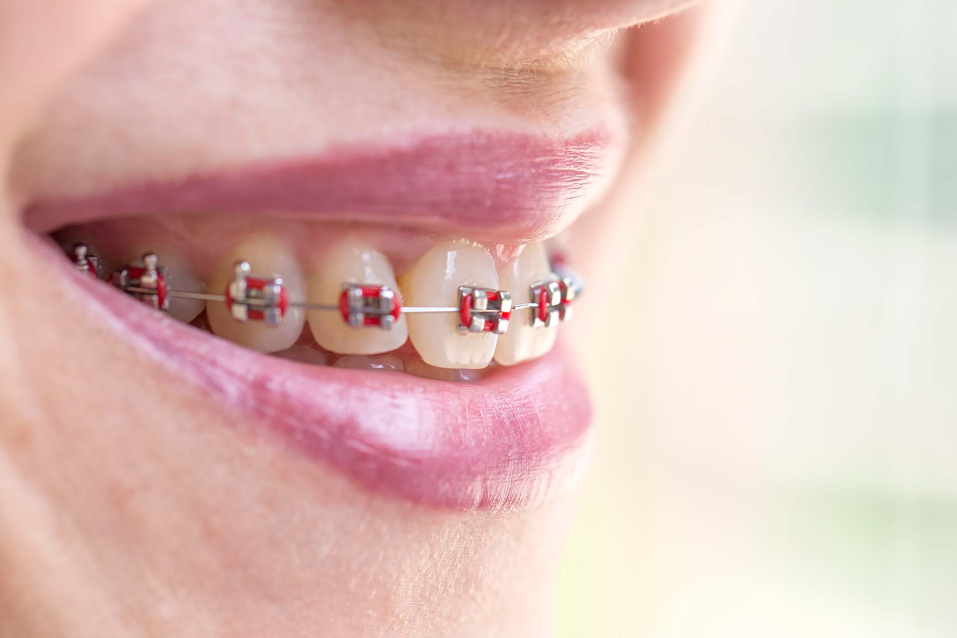 Sonrisa con brackets — ortodoncia en Mérida